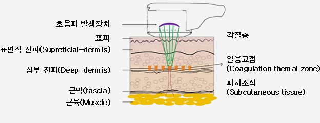 초음파 시술 장치 이해를 돋기위한 이미지