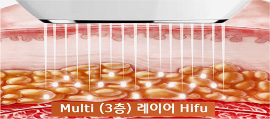 Multi(3층) 레이어 Hifu